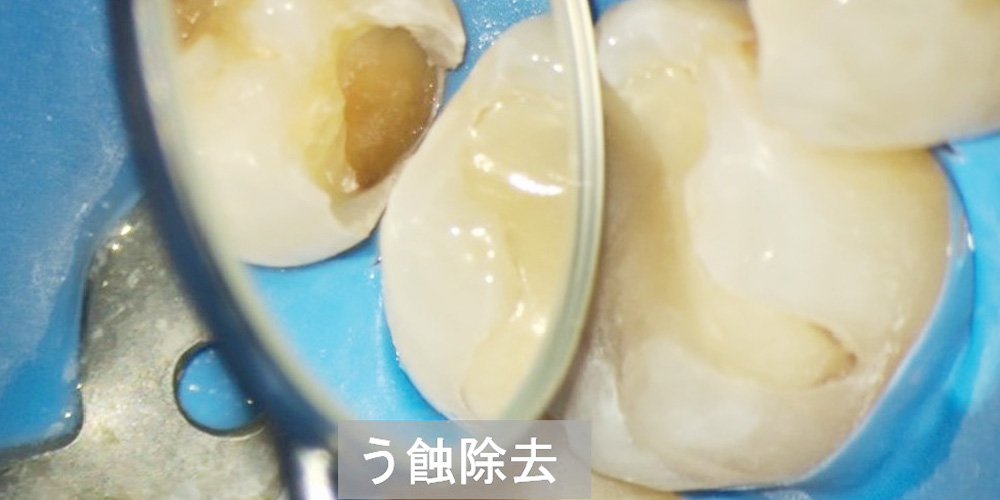 う蝕を除去