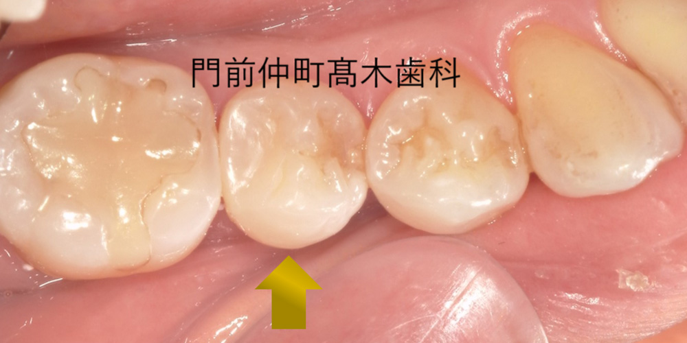 治療後②