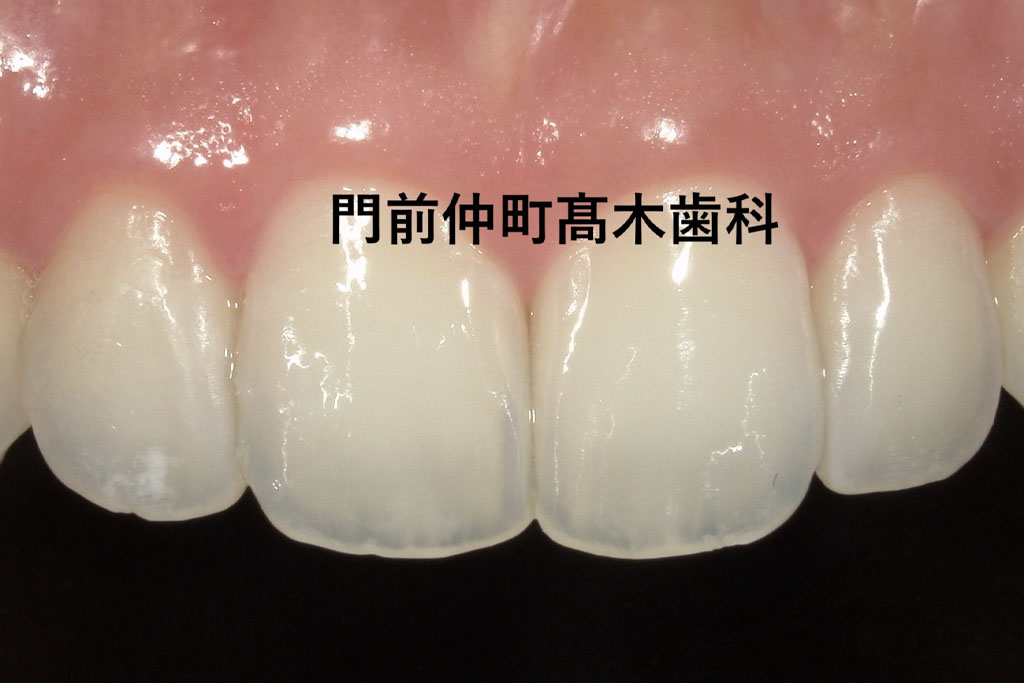 ホワイトスポット(アイコン)治療