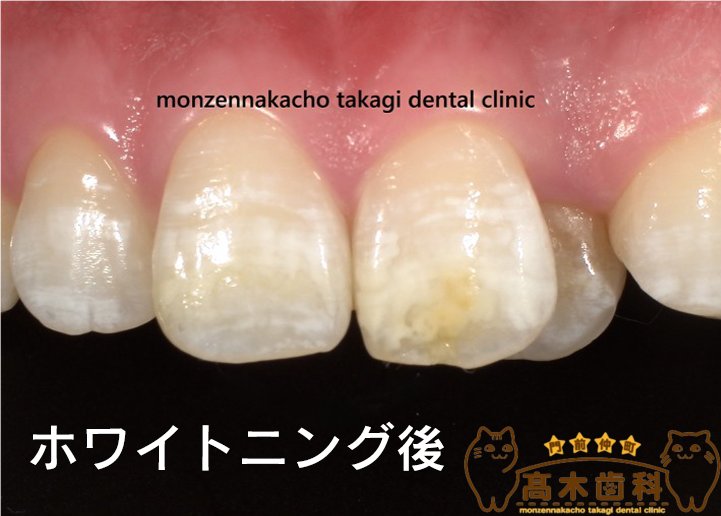 ホワイトニング後