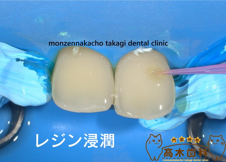 レジン浸潤