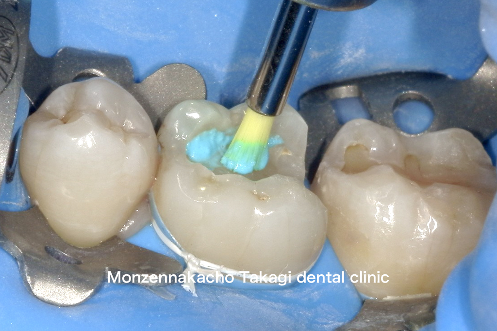 ラバーダム防湿を仕様したセラミック治療