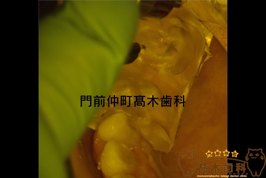コンポジットレジンべニア症例