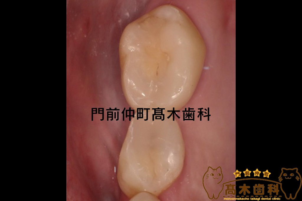 コンポジットレジンべニア症例