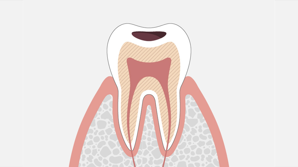 虫歯は進行段階C2