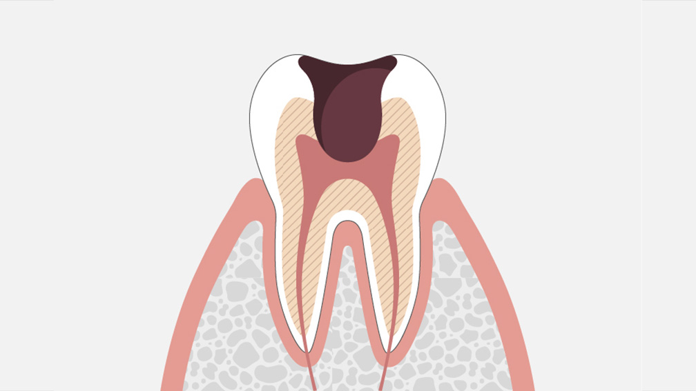 虫歯は進行段階C3