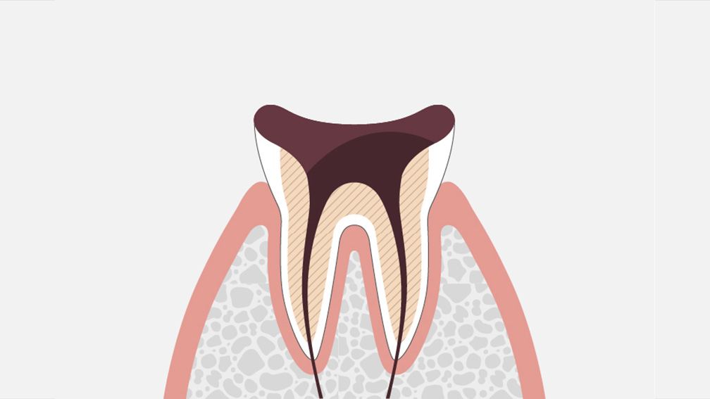 虫歯は進行段階C4