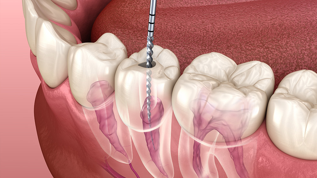 根管治療とは
