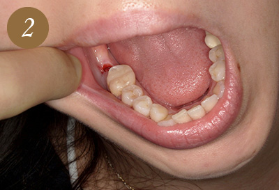 歯肉の除去
