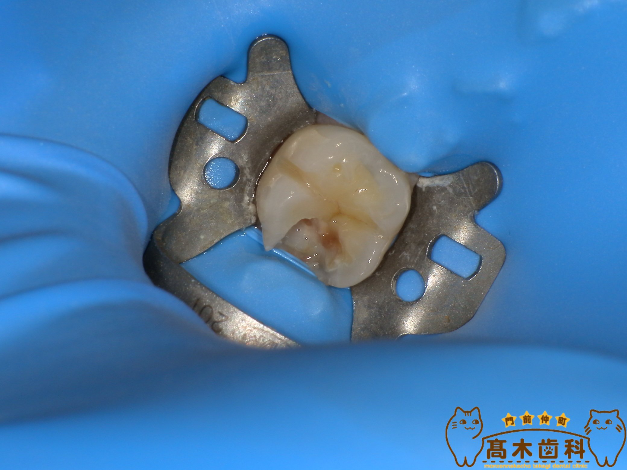ラバーダム防湿を行った精密虫歯治療