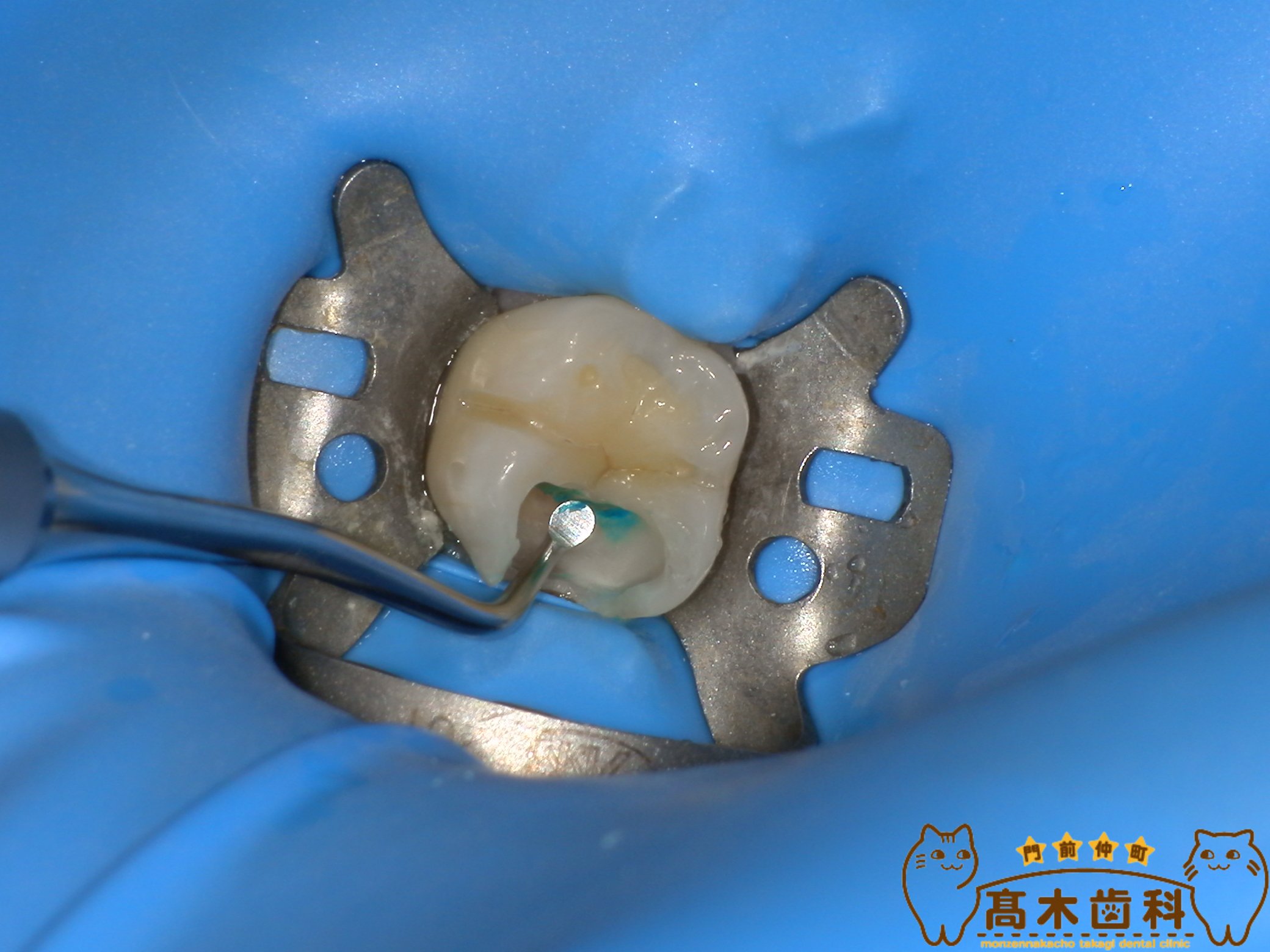 ラバーダム防湿を行った精密虫歯治療
