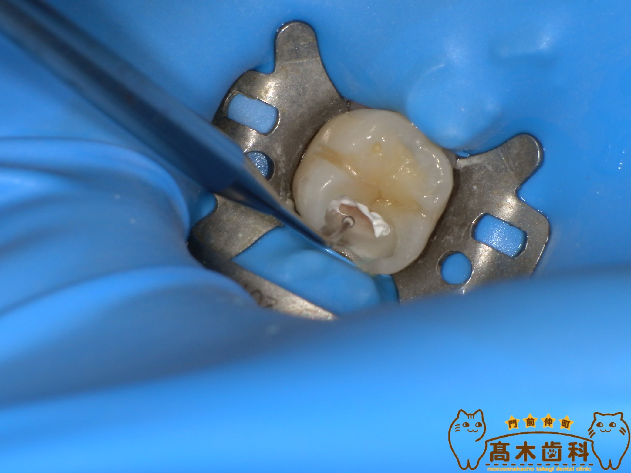 ラバーダム防湿を行った精密虫歯治療