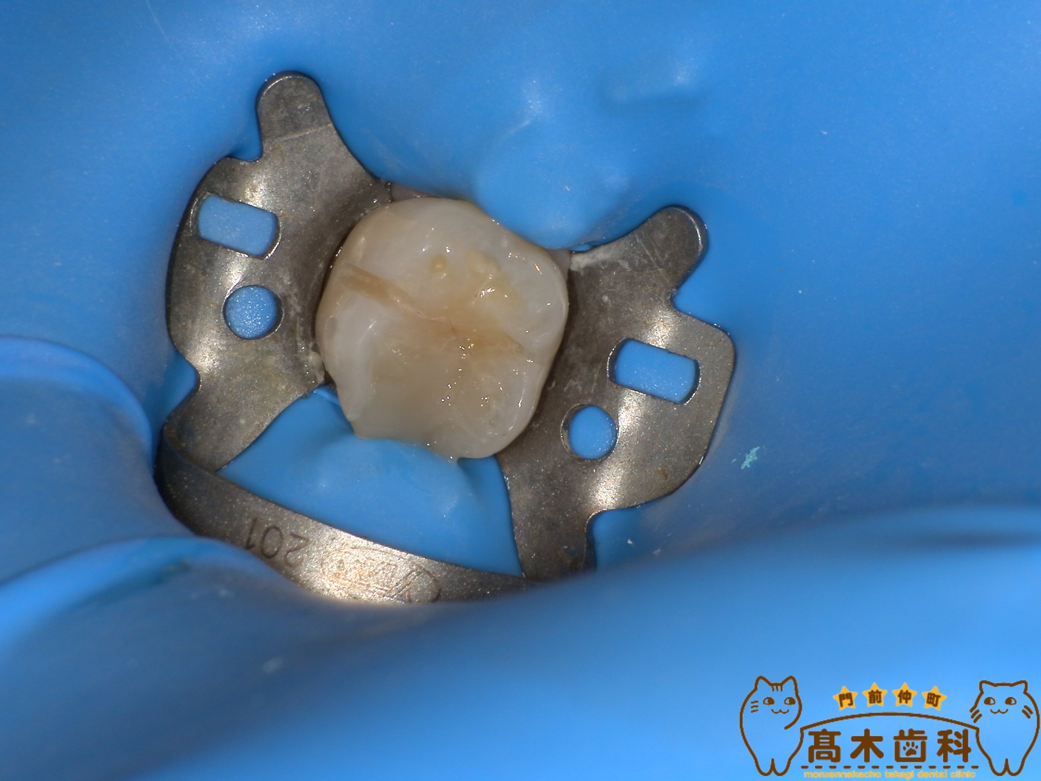 ラバーダム防湿を行った精密虫歯治療